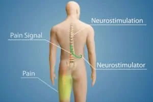 Chronic Back Pain