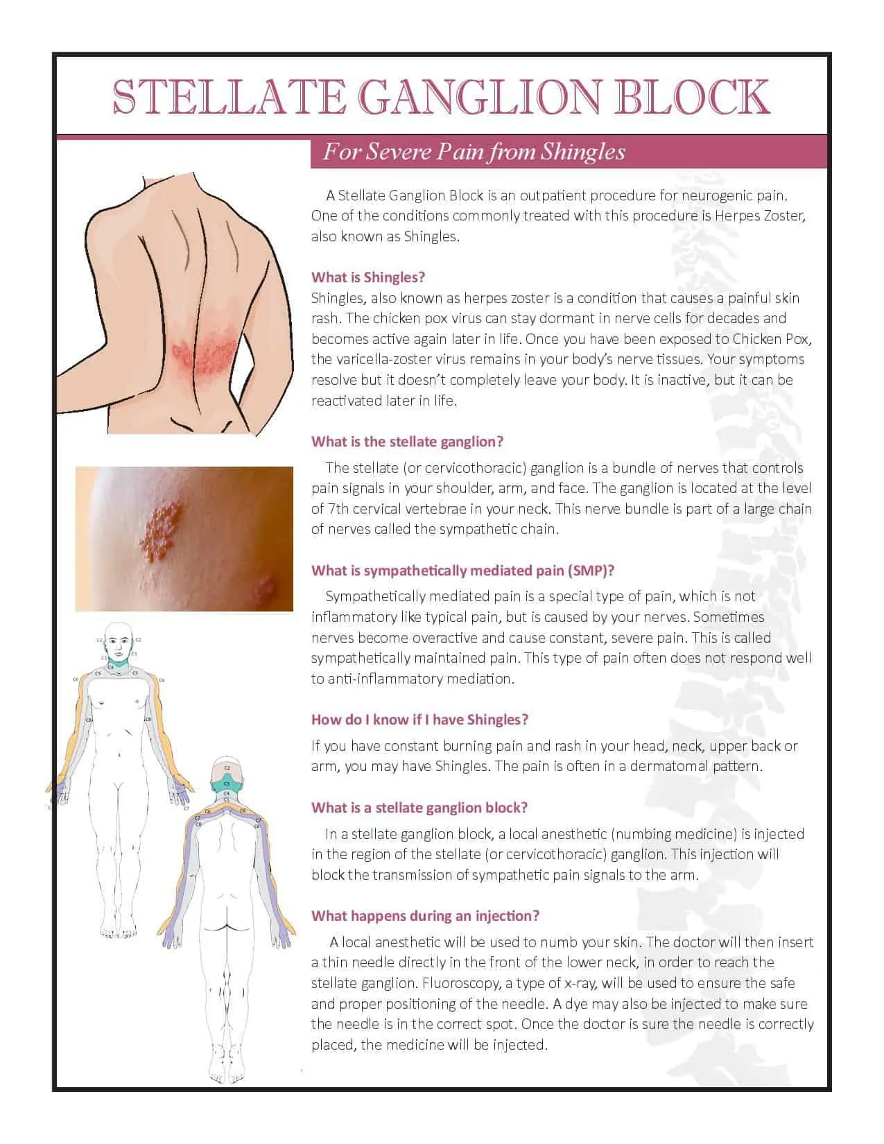 Stellate Ganglion Block for Shingles 2018-page-001