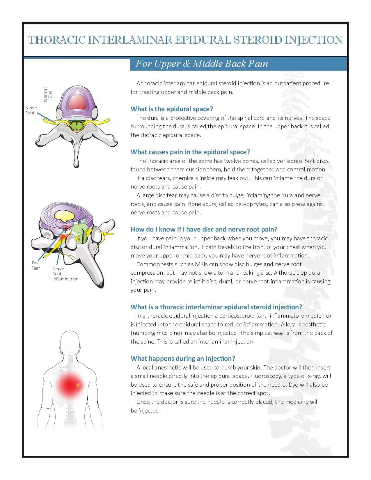 Thoracic ESI Interlaminar Brochure PDF 2018-page-001