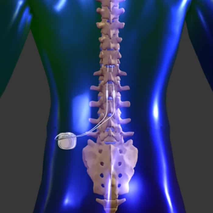spinal cord stimulation by abbott